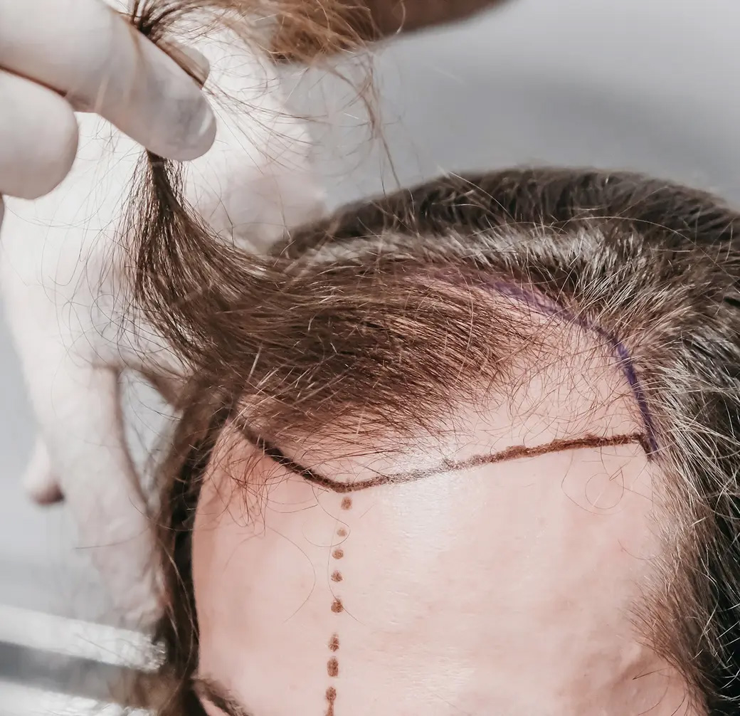 The Best Hair Transplant Surgery in Florida